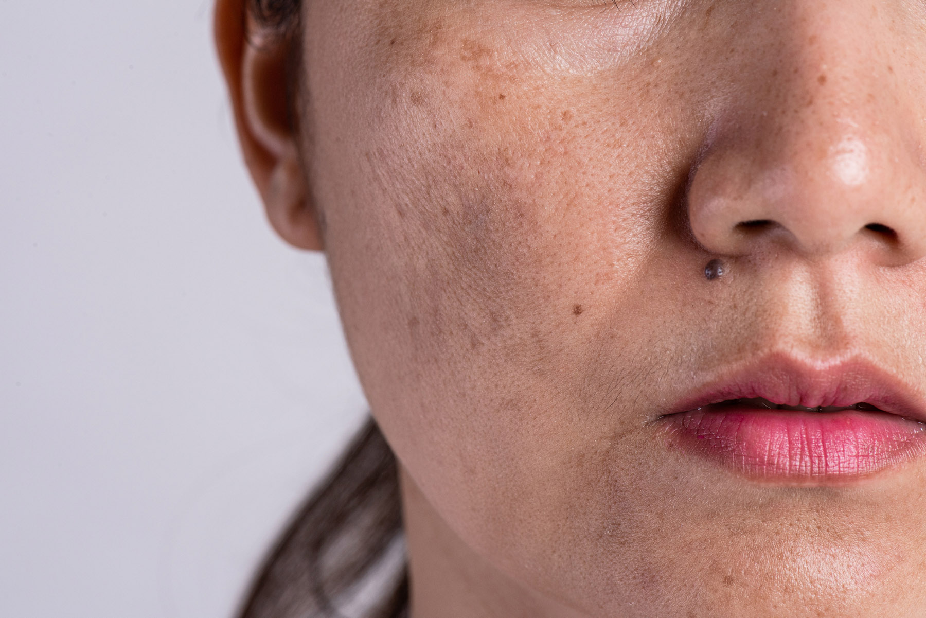 Pigmentation Thames Skin Clinic